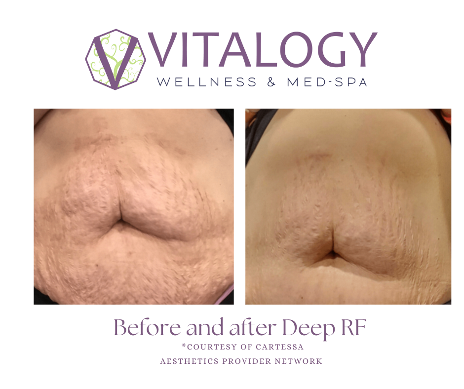 Before and After Deep RF at Vitalogy Wellness and Med Spa