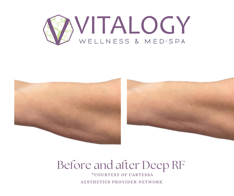 Before and After Deep RF at Vitalogy Wellness and Med Spa