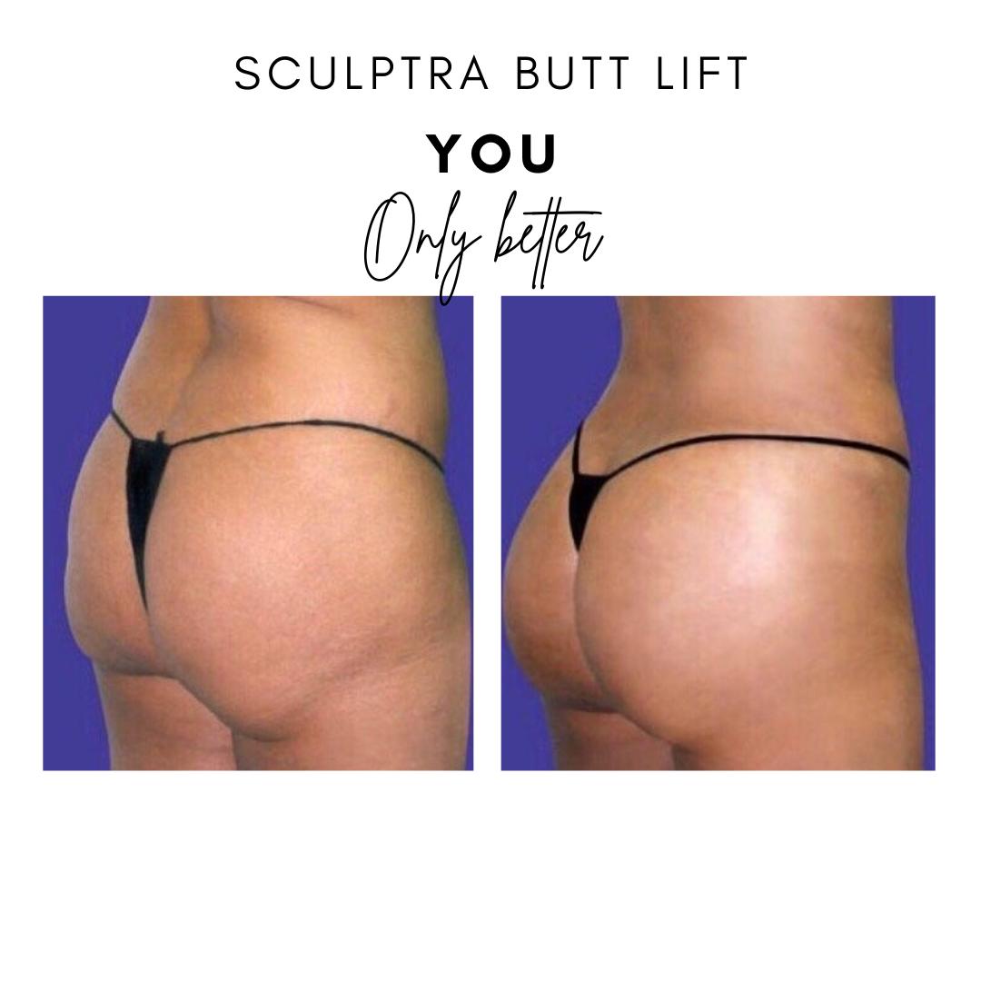 Sculptra Butt Lift a non surgical alternative to the BBL