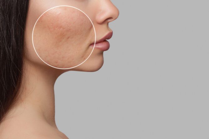 Acne Scar Treatment in Homewood, Alabama