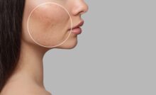 Acne Scar Treatment at Vitalogy Wellness and Med Spa