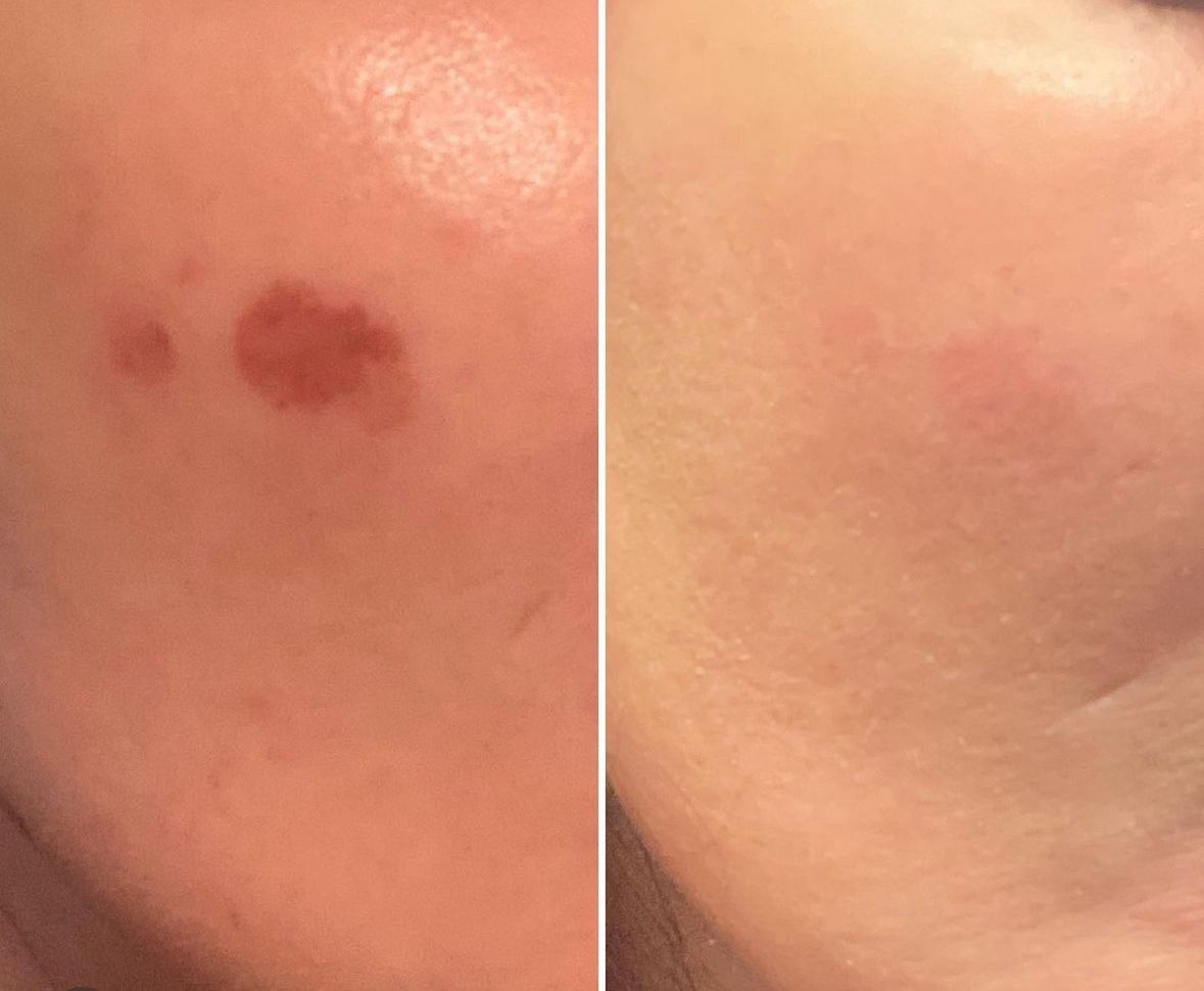 before and after 2 weeks of 1 laser treatment and regular skin care (obagi lightening cream) and skin better science SPF