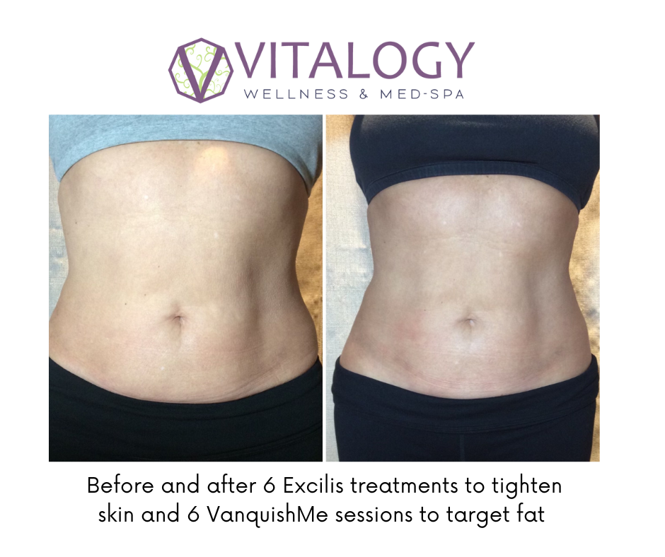 Before and after Excilis & Vanquish Body Contouring-  By Dr. Farah Sultan at Vitalogy Wellness & Medical Spa in Homewood, Alabama