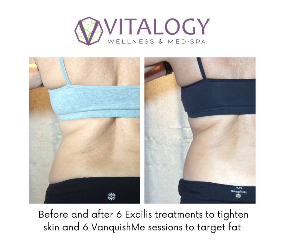 Before-and-after-Excilis-Vanquish-Body-Contouring-By-Dr.-Farah-Sultan-at-Vitalogy-Wellness-Medical-Spa