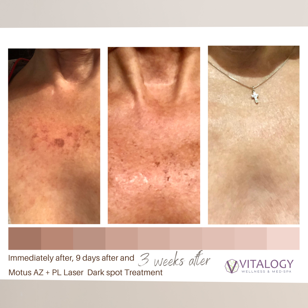 Before-and-after-pigment-reduction-with-Motus-AZ-at-Vitalogy