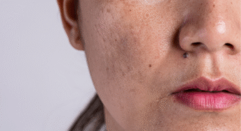 PRX DermPerfexion and PRX Plus in Homewood AL, Skin Rejuvenation Without Downtime