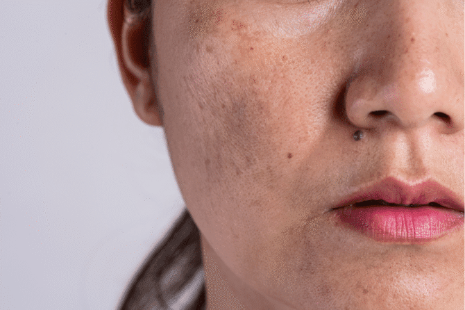 PRX DermPerfexion and PRX Plus in Homewood AL, Skin Rejuvenation Without Downtime