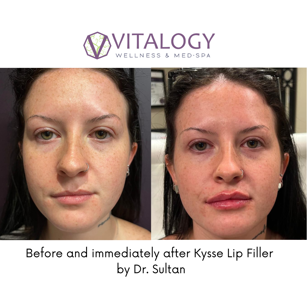Before and immediately after Kysse Lip Filler by Dr. Sultan in Homewood, AL