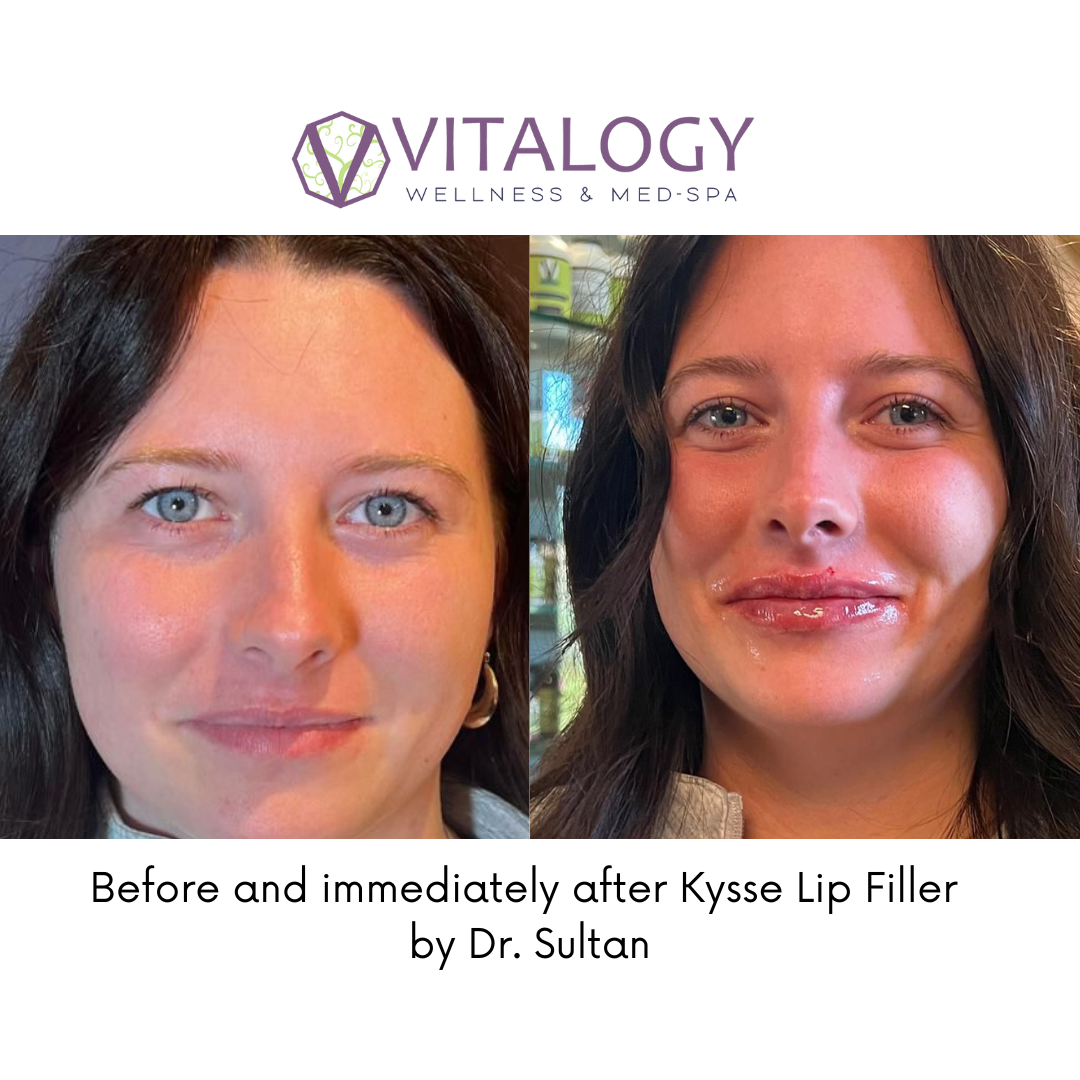 Before and immediately after Kysse Lip Filler by Dr. Sultan in Homewood, AL