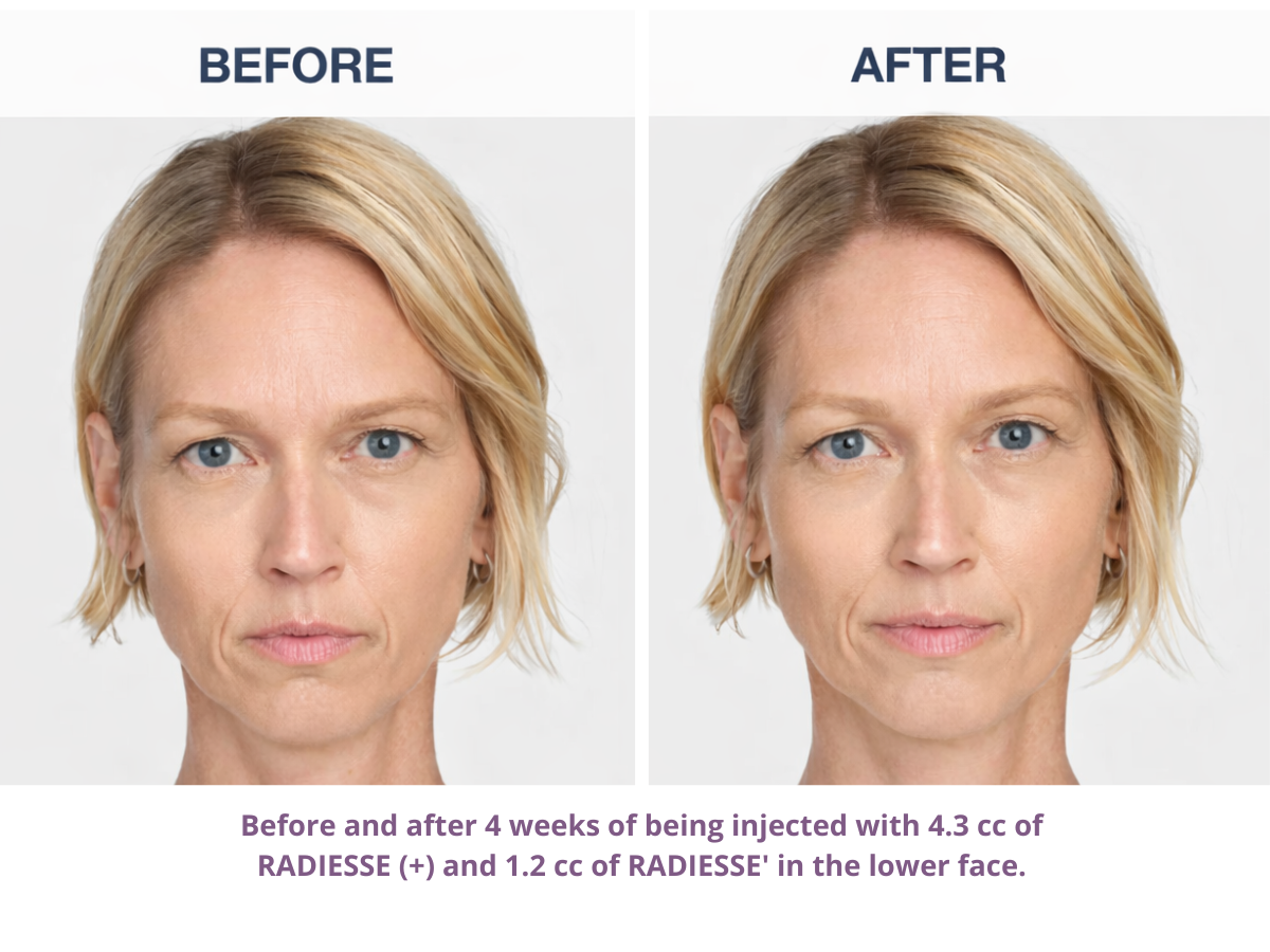 Before and after 4 weeks of receiving 4.3 cc of RADIESSE to the face.