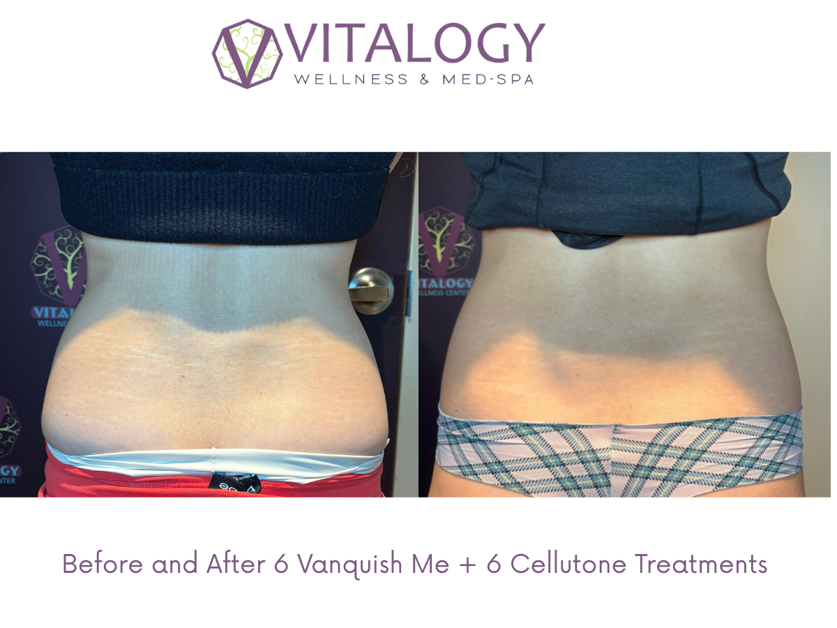 Before and After 6 Vanquish Me + 6 Cellutone Treatments