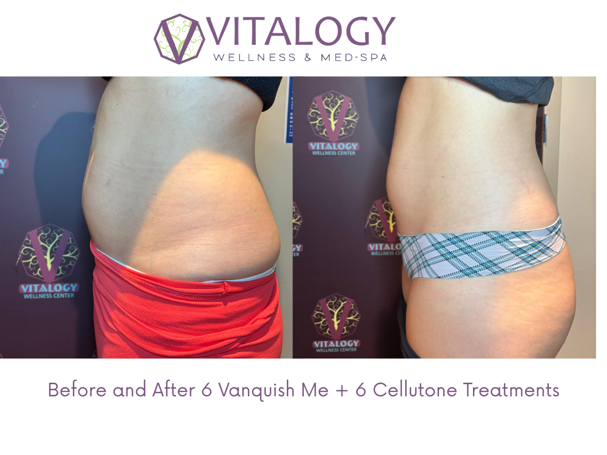 Before and After 6 Vanquish Me + 6 Cellutone Treatments