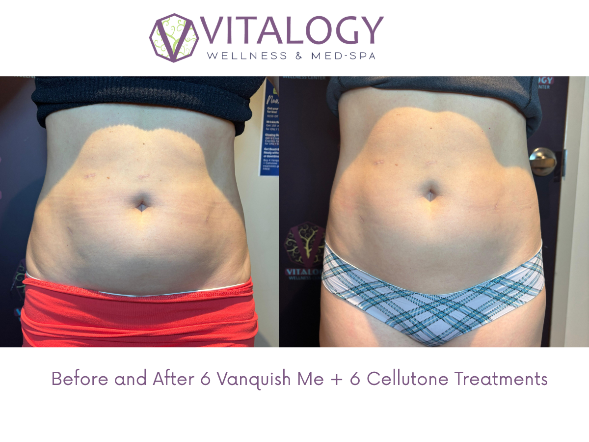 Before and After 6 Vanquish Me + 6 Cellutone Treatments