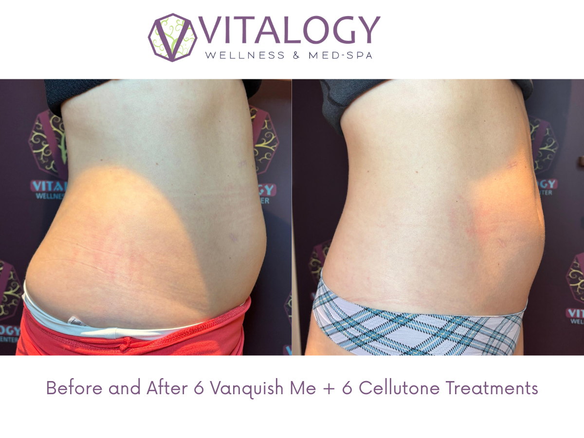 Before and After 6 Vanquish Me + 6 Cellutone Treatments