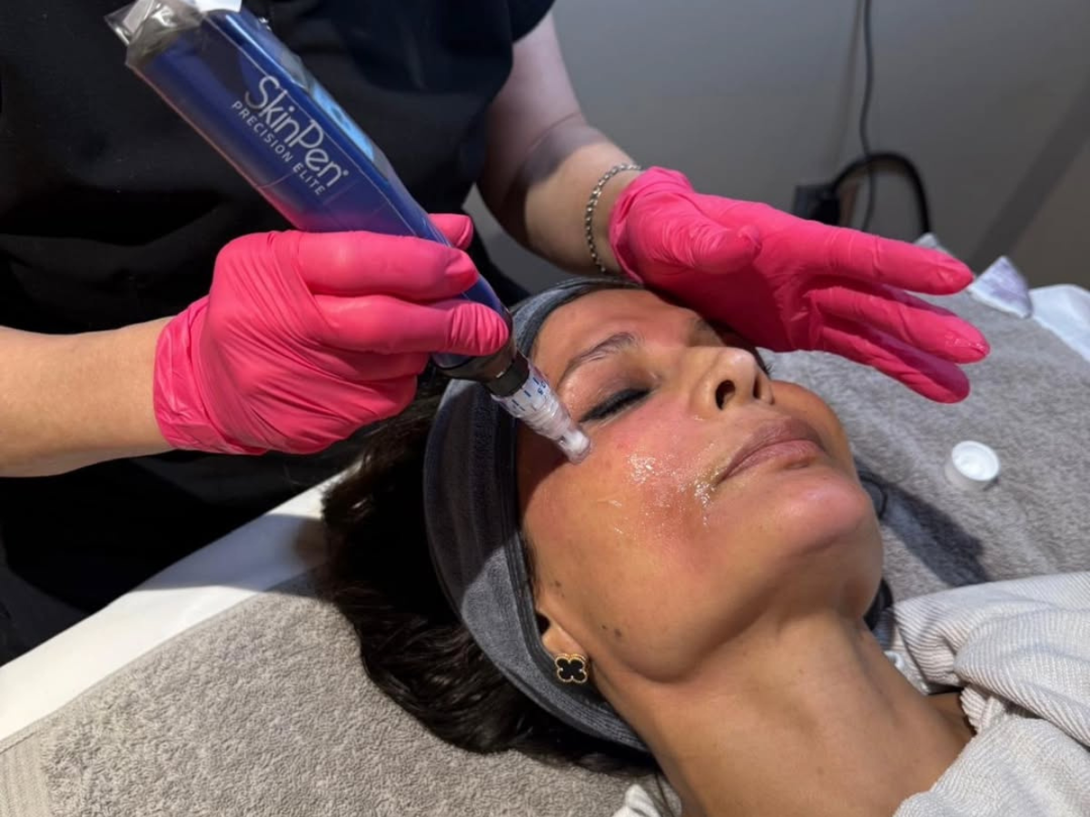SkinPen at Vitalogy Wellness and Med Spa SkinPen at Vitalogy Wellness and Med Spa